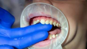 Çocuklarda Estetik Bölge Restorasyonları