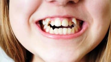 erken dönem ortodontik tedaviler