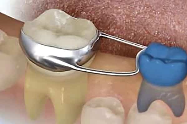 yer tutucu uygulamaları