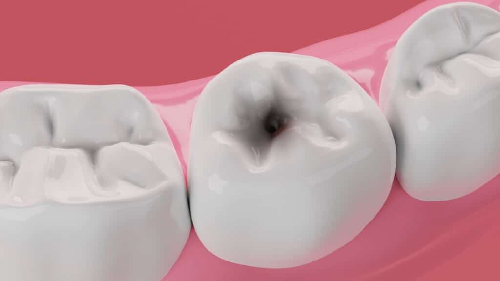 Çocuklarda Diş Çürüğü Çeşitleri Nelerdir?