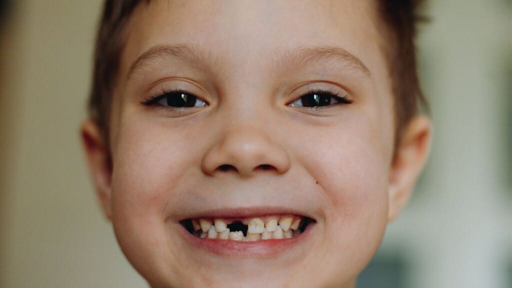 Diş travması nedir